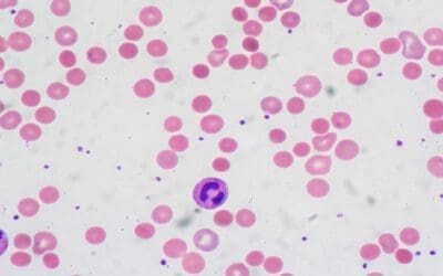 Warm Autoimmune Hemolytic Anemia (warm AIHA)