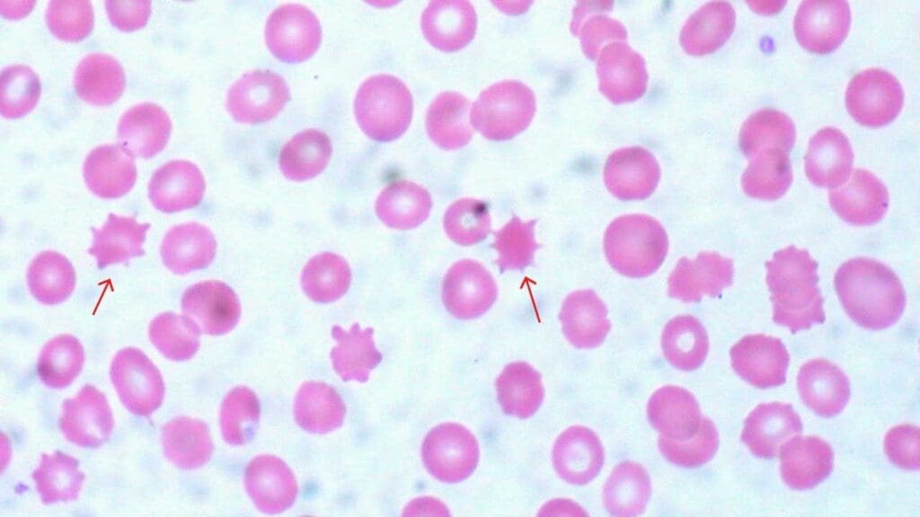 Diagram of a peripheral blood smear showing several red blood cells (acanthocytes) marked with a red arrow. These acanthocytes have numerous, irregularly spaced spikes projecting from their surfaces, giving them a spiky or spur-like appearance