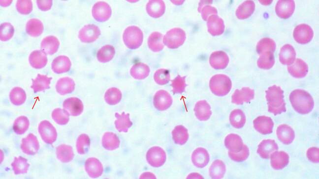 Acanthocyte Microscope Abnormal Red Blood Cell Morphology: Causes & Interpretation