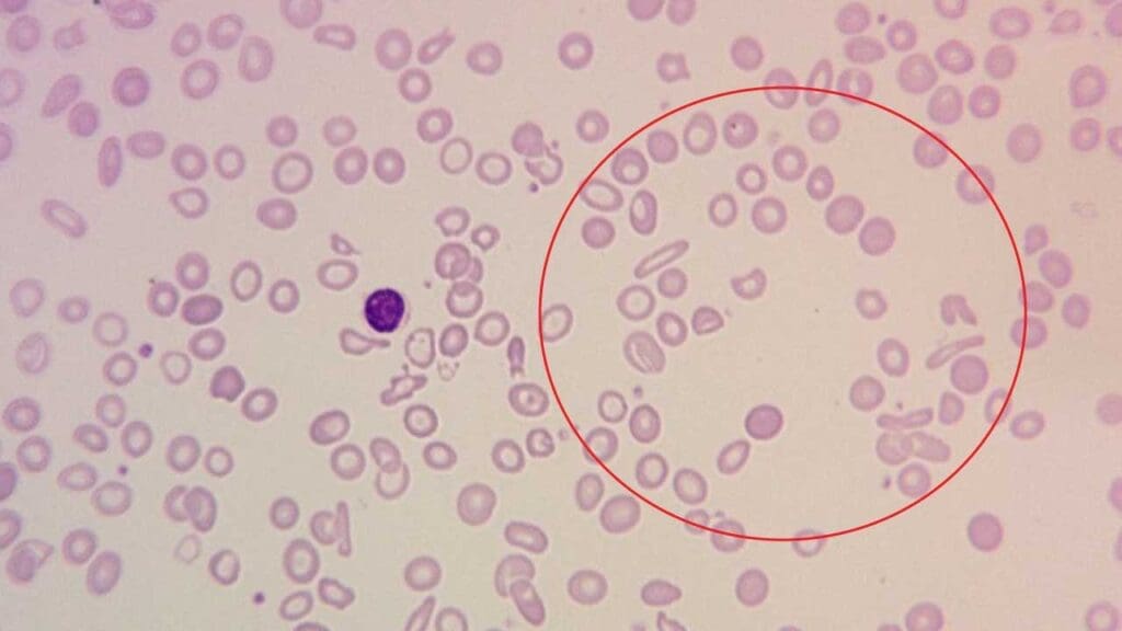The presence of marked anisopoikilocytosis in RBC morphology of severe anemia highlights the severity of the condition and the potential urgency for diagnosis and treatment.