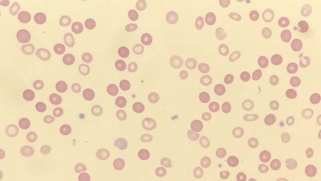 Peripheral blood smear showing dimorphic RBC morphology after a blood transfusion 