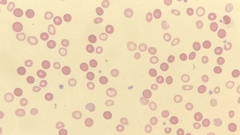 Red Blood Cell (RBC) Abnormal Morphology: Description and Causes