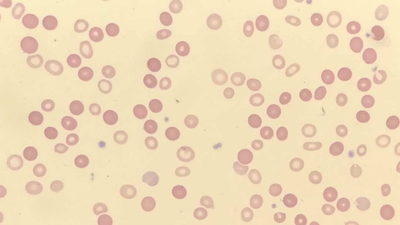 Red Blood Cell (RBC) Abnormal Morphology: Description and Causes