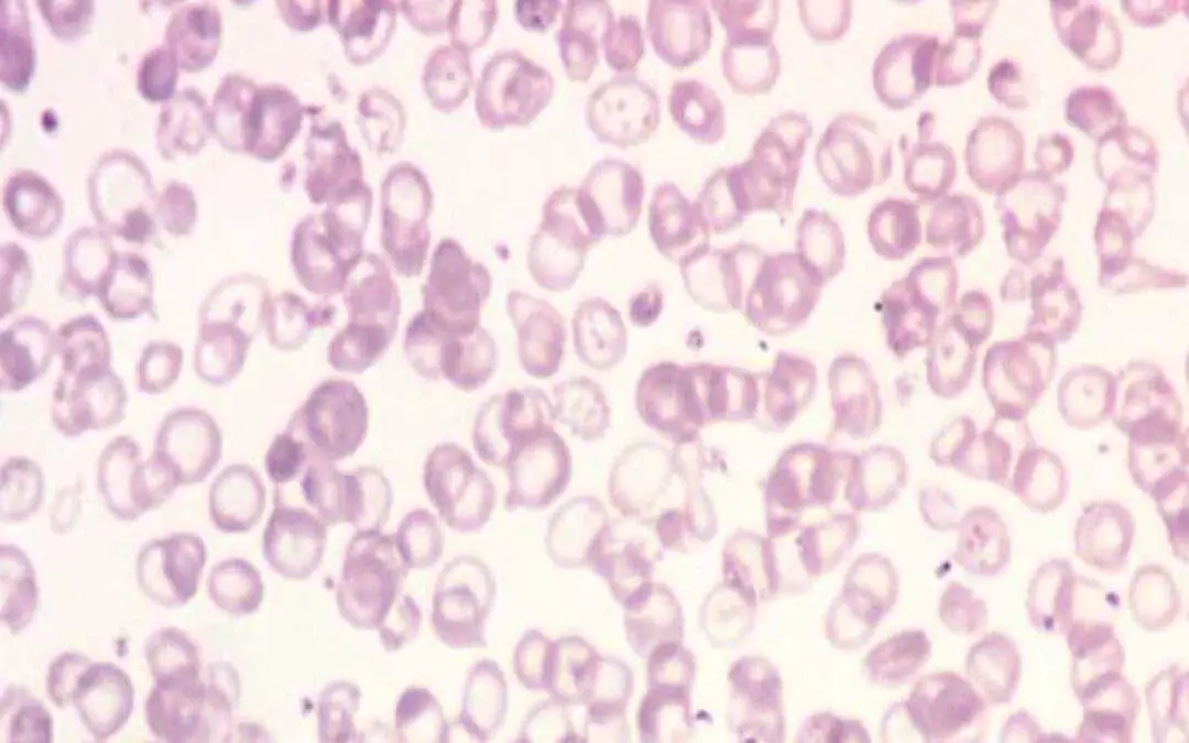 Thalassemia