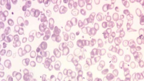 Abnormal Red Blood Cell Morphology: Causes & Interpretation