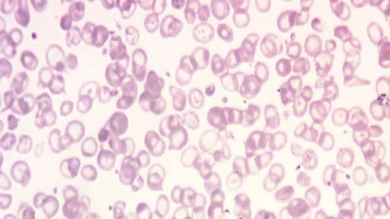 Abnormal Red Blood Cell Morphology: Causes & Interpretation