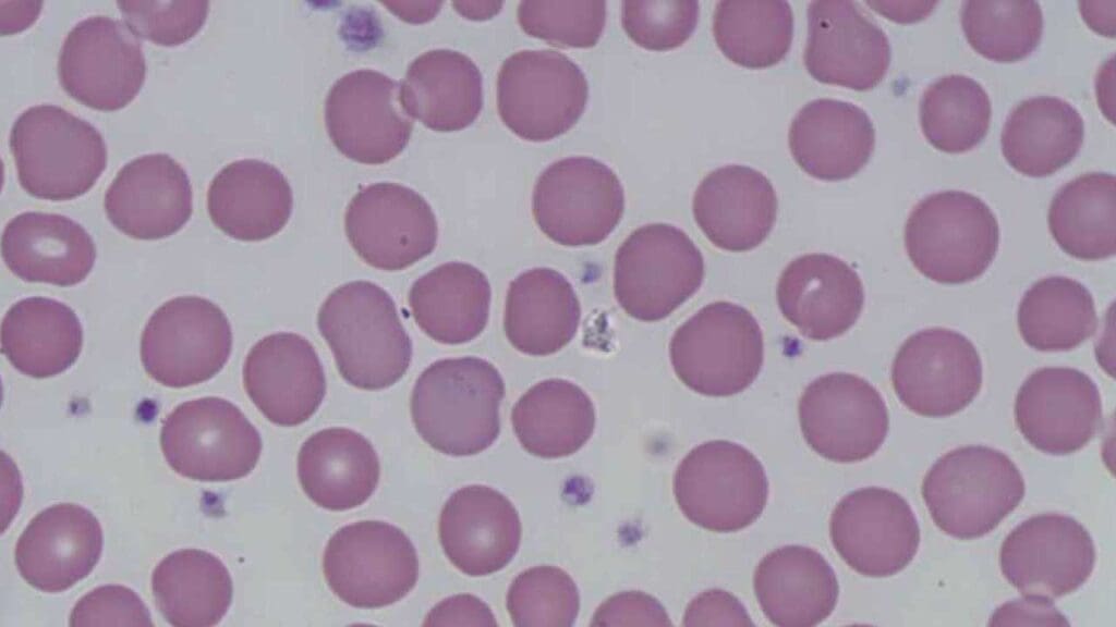 Macrocytic red cells in the peripheral blood films. These red cells are larger than their healthy counterparts