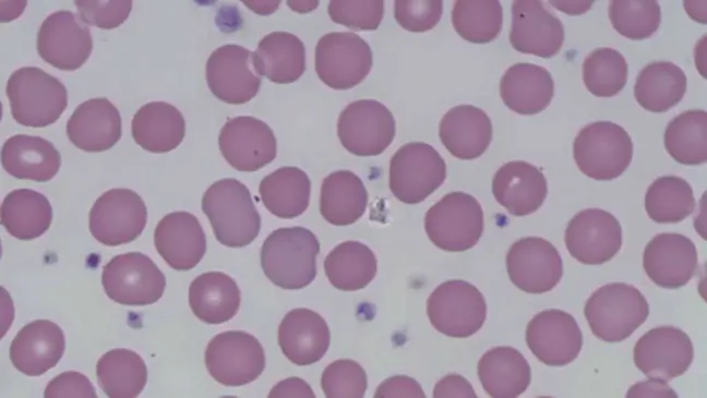 Abnormal Rbc Cell Abnormal Red Blood Cell Morphology: Causes & Interpretation