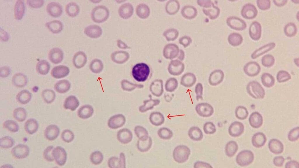 Diagram of microcytic red blood cells, appearing smaller than a normal lymphocyte in the center for size comparison. These smaller, rounder cells are characteristic of iron deficiency anemia and thalassemias, conditions that limit hemoglobin production.