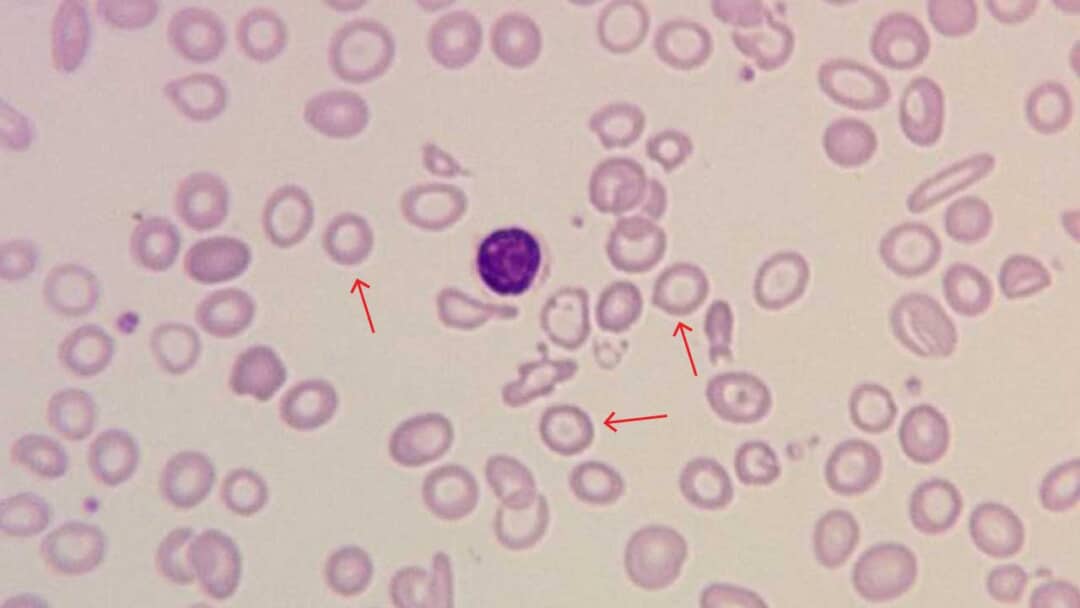 Red Blood Cell (RBC) Abnormal Morphology: Description and Causes