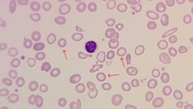 Abnormal Red Blood Cell Morphology: Causes & Interpretation