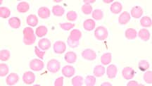 Red Blood Cell (RBC) Abnormal Morphology: Description and Causes