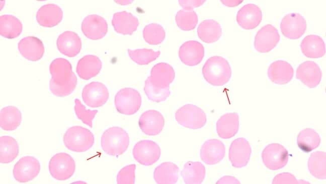 Abnormal Red Blood Cell Morphology: Causes & Interpretation