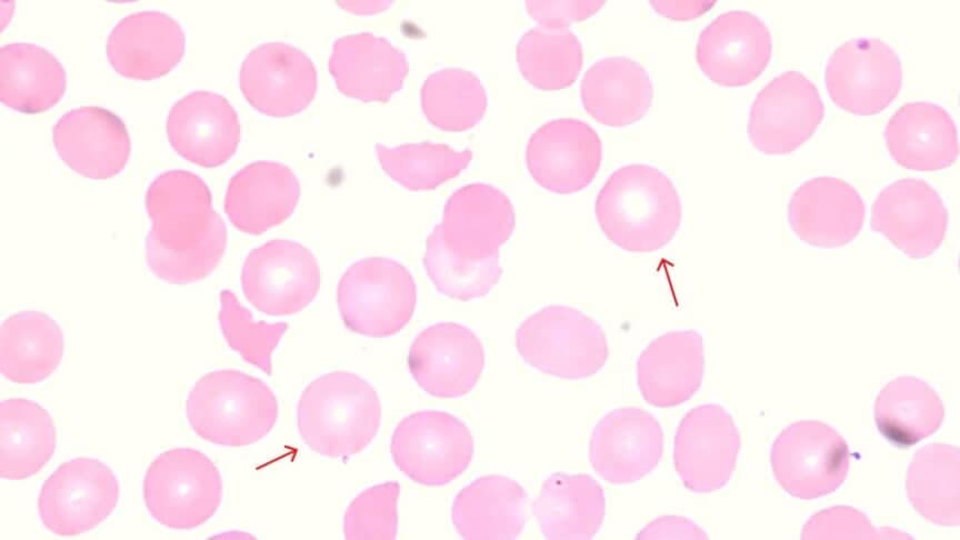 Red Blood Cell (RBC) Abnormal Morphology: Causes & Interpretation