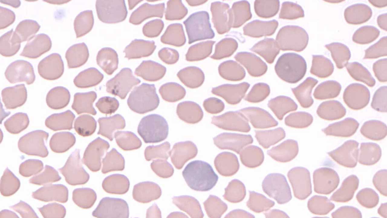 Stained Rbc Slides Abnormal Red Blood Cell Morphology: Causes & Interpretation