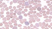 Polychrom Rbcs Red Blood Cell (RBC) Abnormal Morphology: Description and Causes