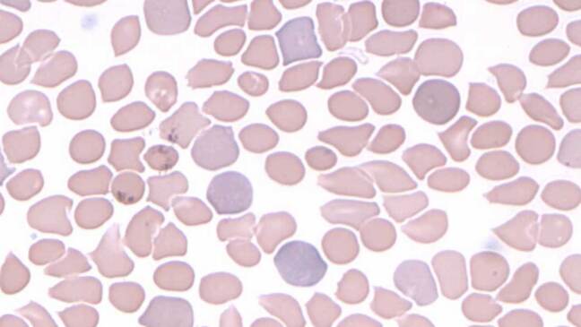 Abnormal Red Blood Cell Morphology: Causes & Interpretation