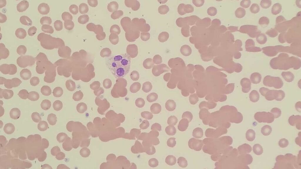 Red blood cell agglutination due to cold agglutinin in the peripheral blood smear