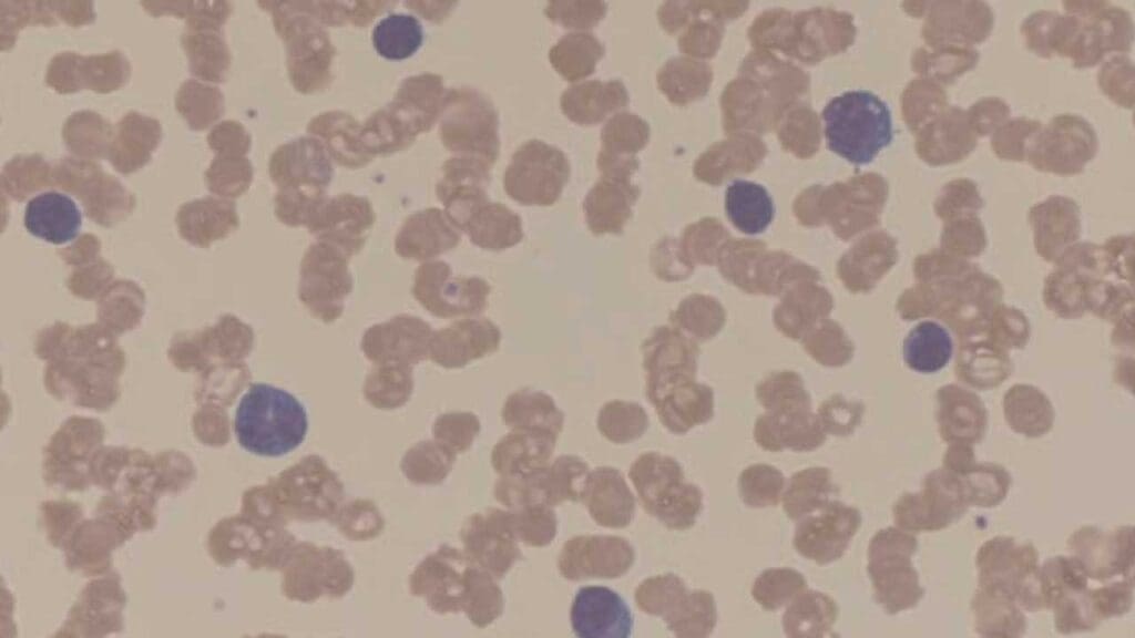 Rouleaux formation, pronounced "roo-loh," is a phenomenon observed on a peripheral blood smear where red blood cells (RBCs) appear stacked face-to-face, resembling stacks of coins.  