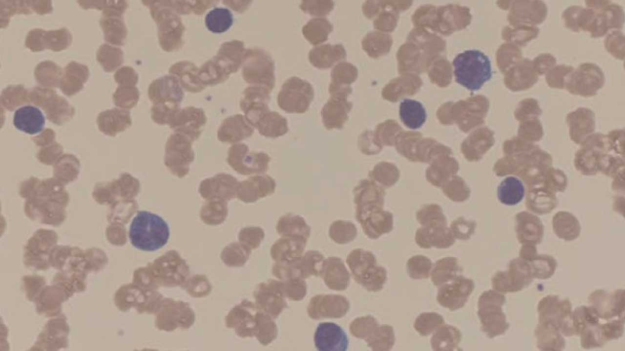 Red Blood Cell (RBC) Abnormal Morphology: Description and Causes