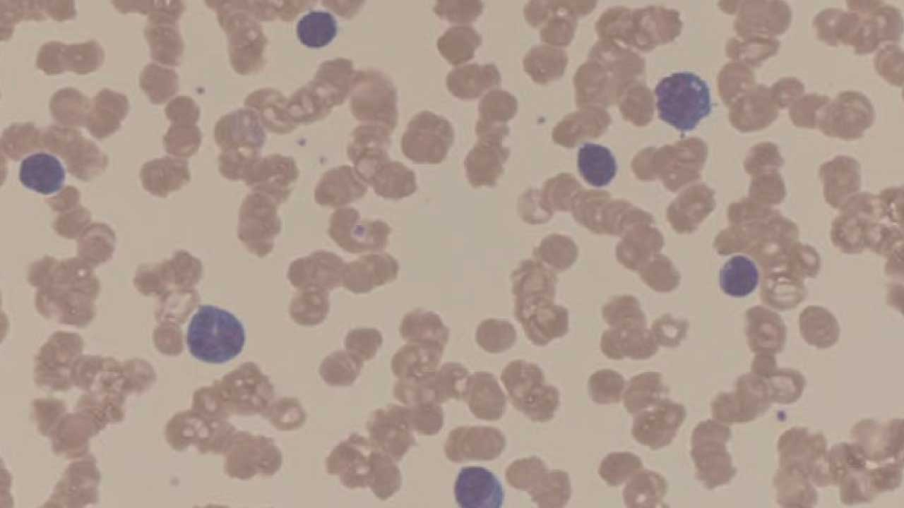 Rouleaux formation, pronounced "roo-loh," is a phenomenon observed on a peripheral blood smear where red blood cells (RBCs) appear stacked face-to-face, resembling stacks of coins.  