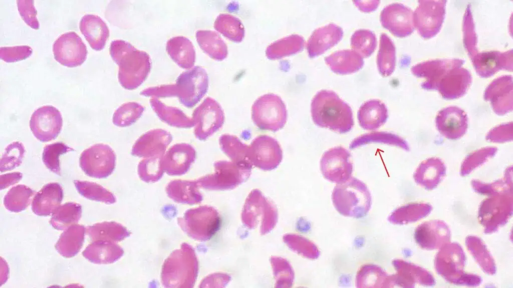 Sickle cells are a characteristic RBC morphology in sickle cell disease
