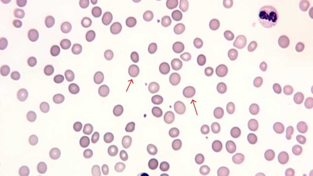 Spherocytes are a type of RBC morphology that are overly round or spheroid in shape instead of being biconcave shape. It is normally seen in the peripheral blood smear of an individual with hereditary spherocytosis