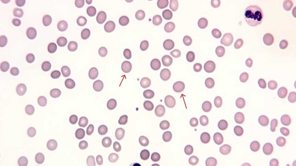 Red Blood Cell (RBC):- Part 5 - RBC Morphology Differential Diagnosis