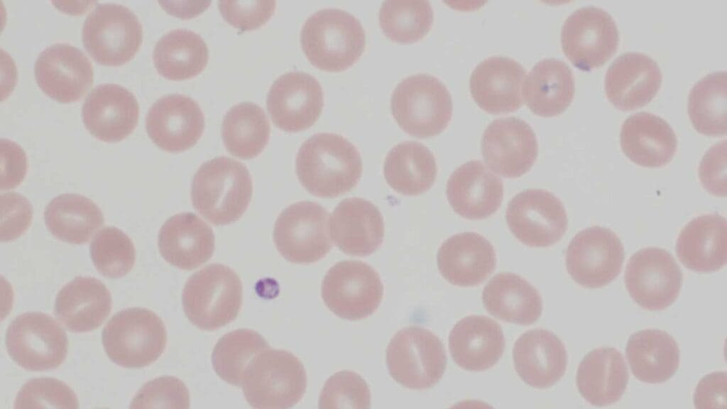 Stomatocytes in the peripheral blood smear. 