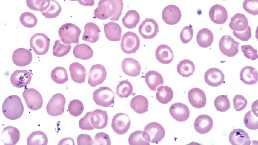 Abnormal Red Blood Cell Morphology: Causes & Interpretation