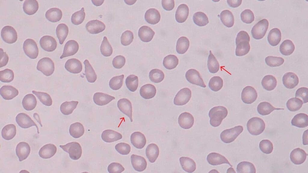 Numerous teardrop cells RBC morphology on a peripheral blood smear