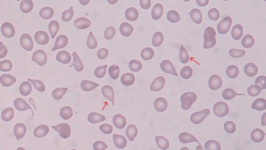 Red Blood Cell (RBC):- Part 5 - RBC Morphology Differential Diagnosis