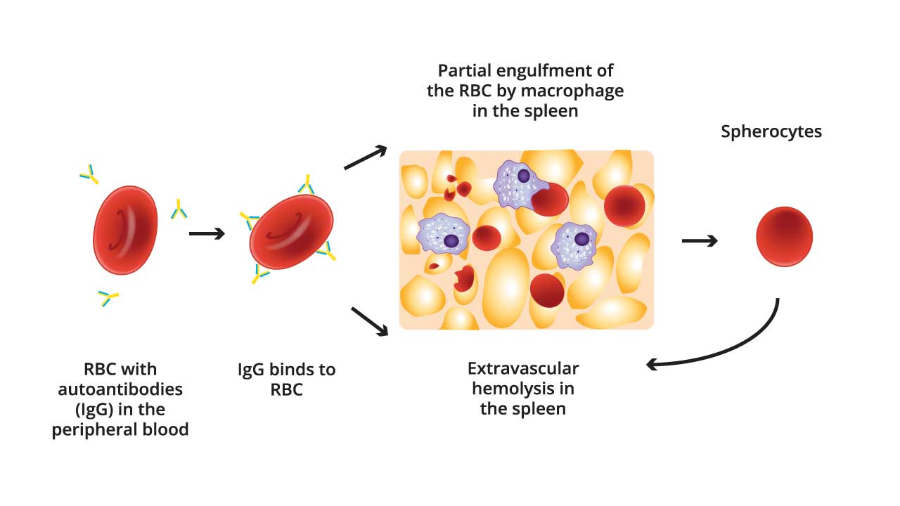 warm autoimmune hemolytic anemia (AIHA). Red blood cells are bound by IgG molecules. The diagram shows the red blood cells being engulfed by macrophages in the spleen. Additionally, some misshapen red blood cells, labeled as spherocytes, are shown leaving the spleen.