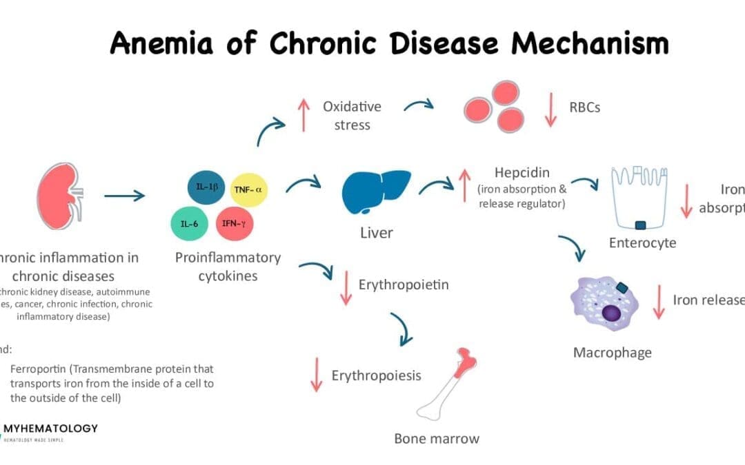 Anemia of Chronic Disease (Anemia of Inflammation)