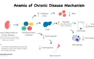 Anemia of Chronic Disease (Anemia of Inflammation)