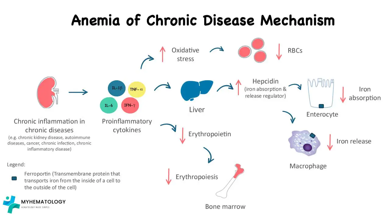 An illustration of the anemia of chronic disease pathophysiology. Pro-inflammatory cytokines causes increase in hepicidin which leads to iron dysregulation, decreased erythropoietin production resulting in low red blood cell production and increased oxidative stress causing shortened red cells lifespan.