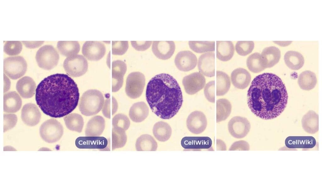Characteristics of Alder anomaly can be seen as coarse basophilic granules in a basophil (left), monocyte (center) and neutrophil (right).