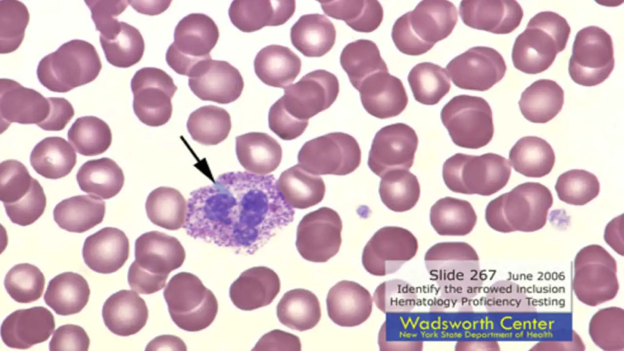 A pale blue or gray oval shaped Döhle body in a neutrophil.