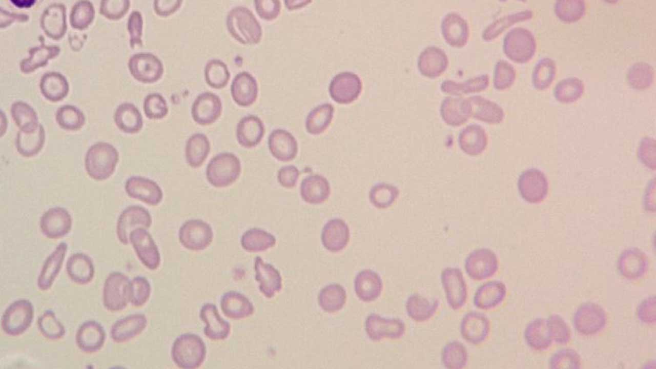 Microscopic examination of a blood smear reveals severe iron deficiency anemia, the most common cause of hypochromic anemia. The red blood cells are small (microcytic) and pale (hypochromic), with some showing a target shape (target cells). Additionally, there's a significant variation in both size and shape of the red blood cells (marked anisopoikilocytosis).