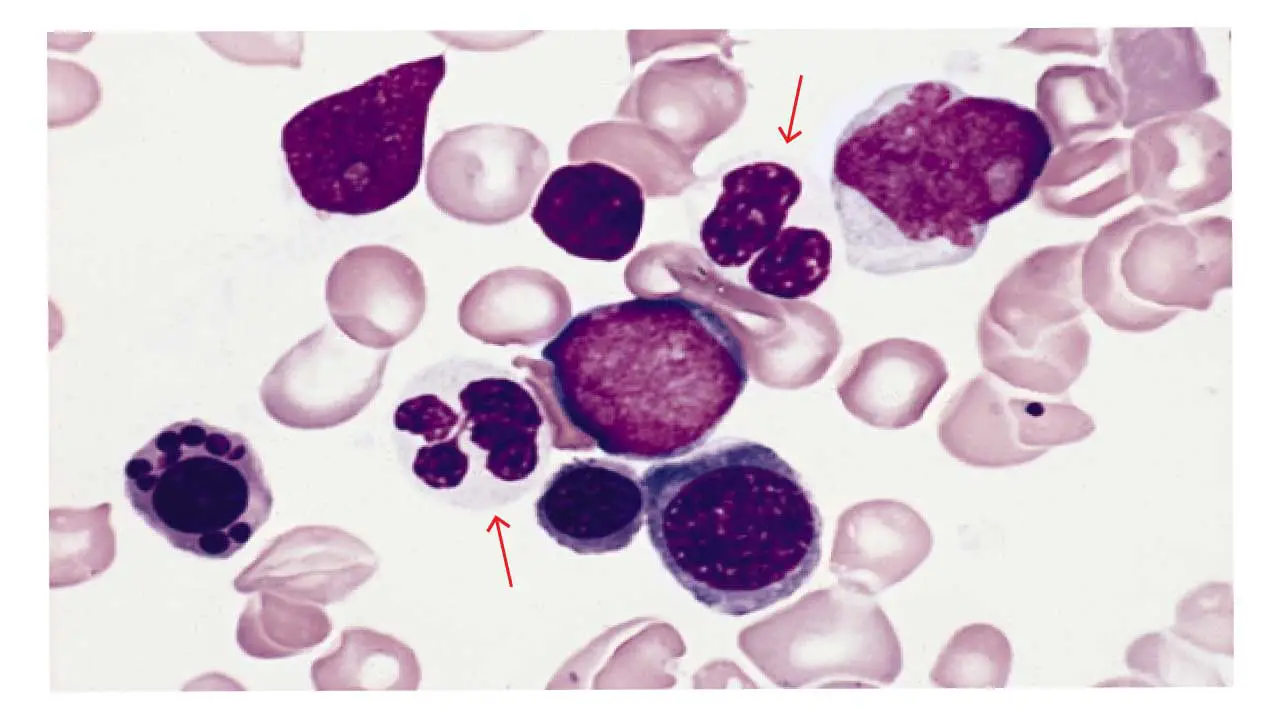 Bone marrow smear from a patient with RAEB. A blast is present in the center. Two abnormal white blood cells (hypogranular neutrophils) (red arrows) are adjacent to the blast. A red blood cell precursor with multiple nuclear fragments is at the lower left. (Wright-Giemsa stain)