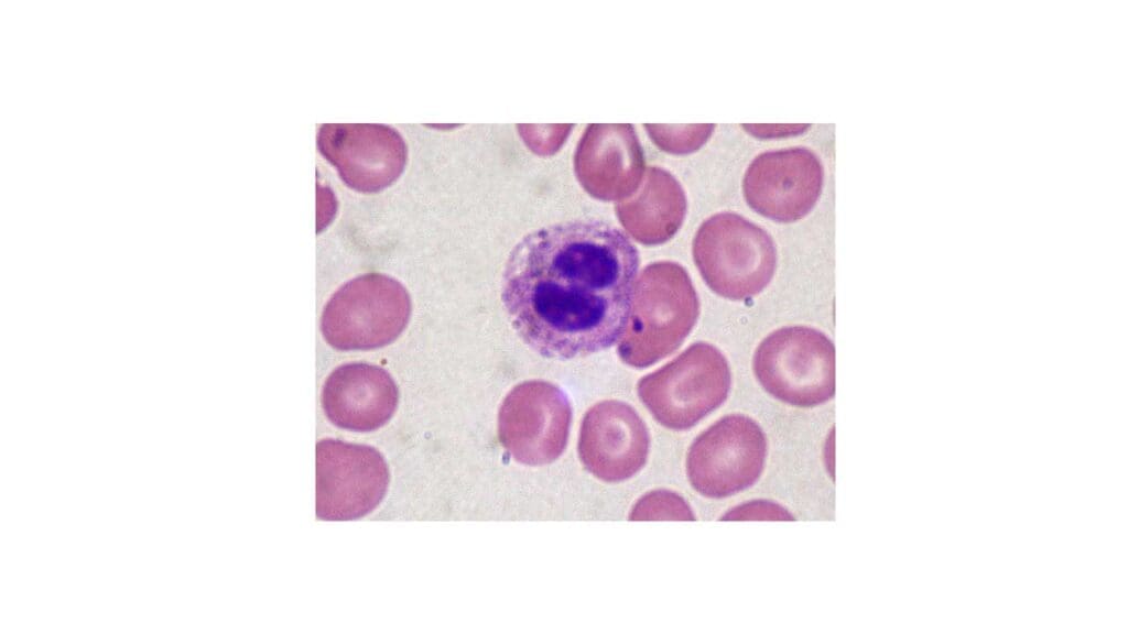 Presence of a Pelger-Huët bilobed neutrophil in a peripheral blood smear. 