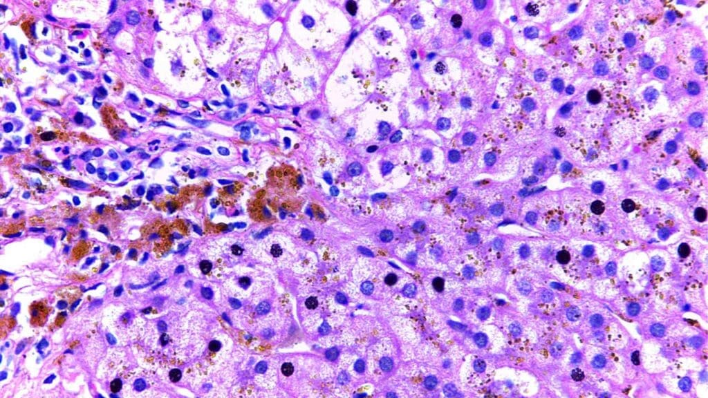 Microscopic image of a hemochromatosis liver. Liver cells (hepatocytes) show coarse, golden-yellow granules of hemosiderin, an iron storage protein, within their cytoplasm. These granules stain blue with Prussian blue stain. This could be see in hereditary hemochromatosis iron overload