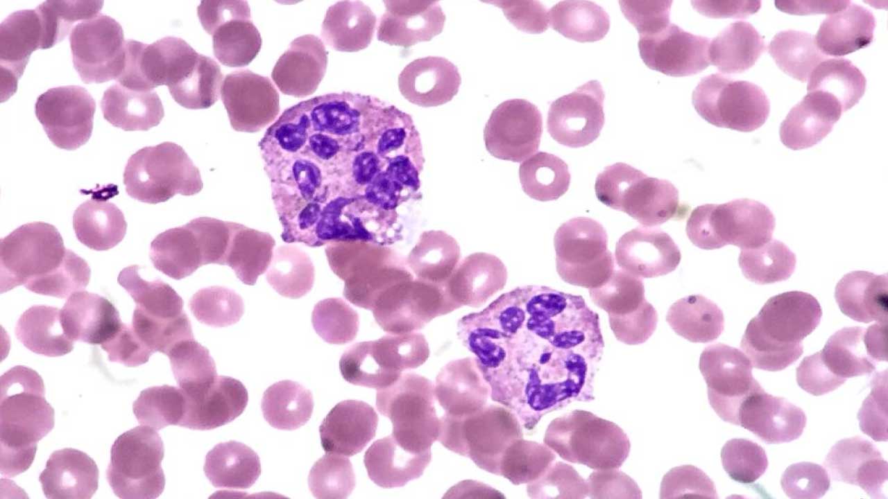 Two hypersegmented neutrophils seen in a peripheral blood smear.