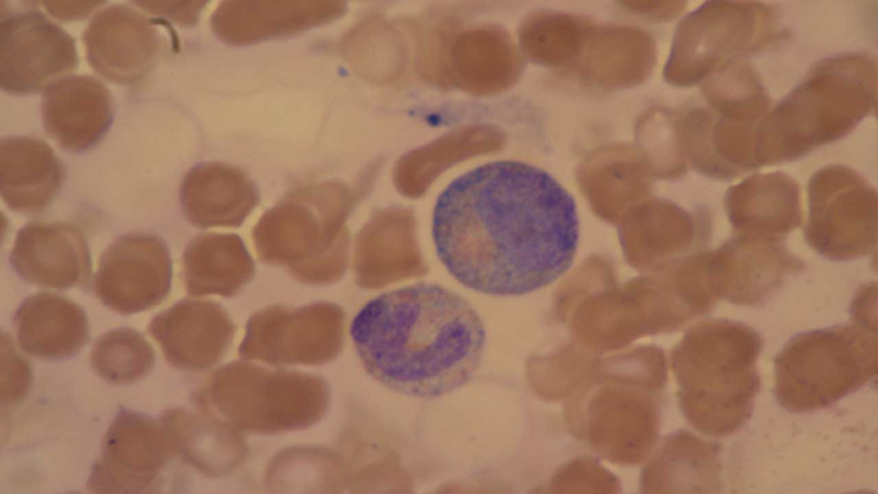 Presence of two abnormal white blood cells (neutrophils) with toxic granulation that stains blue in the smear.