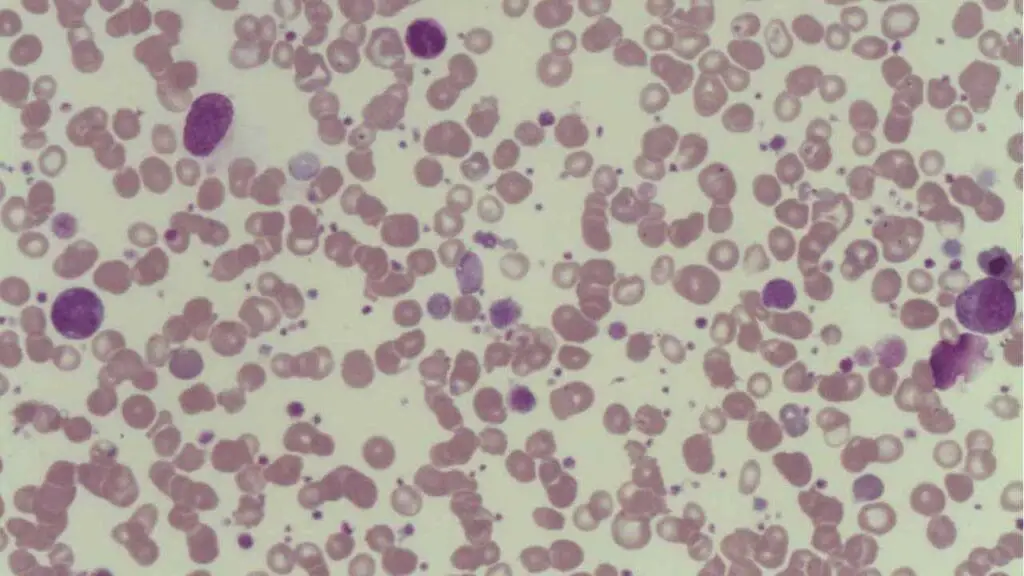 Macrocytic platelet is found in immune thrombocytopenia (ITP)