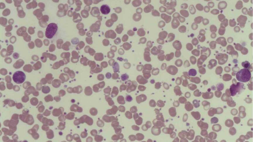 Platelet Function Disorders Causes Symptoms Diagnosis Platelet function disorders causes symptoms diagnosis