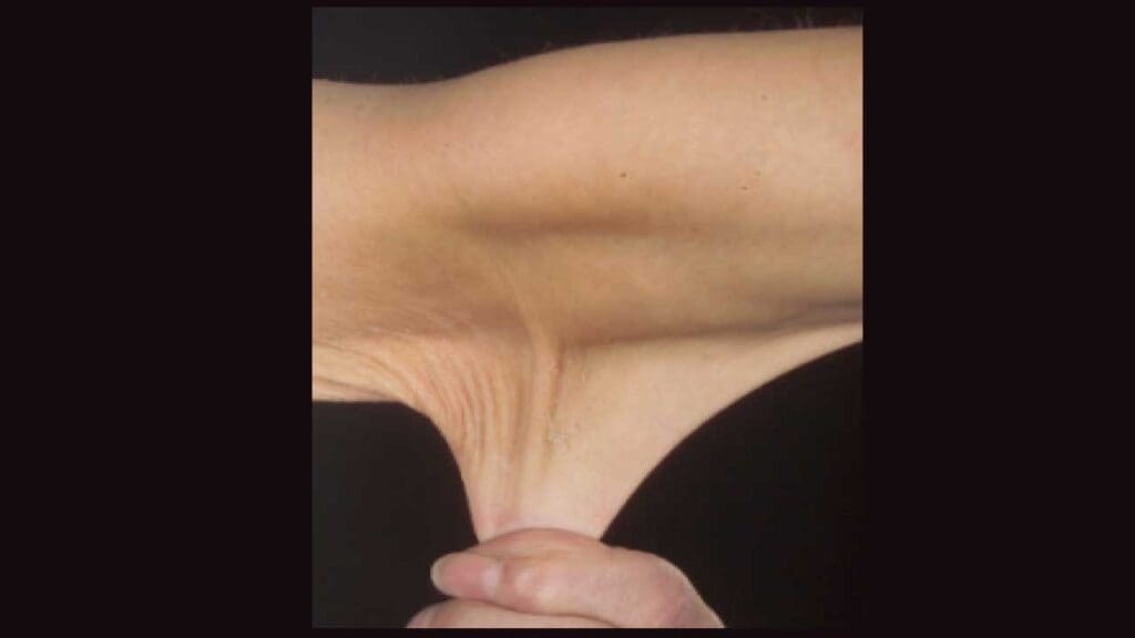 Hyperelastic skin in a person with Ehlers-Danlos syndrome.