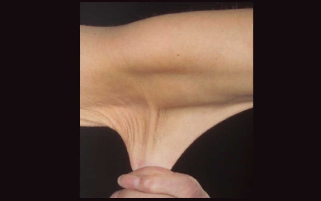 Ehlers-Danlos Syndrome (EDS)