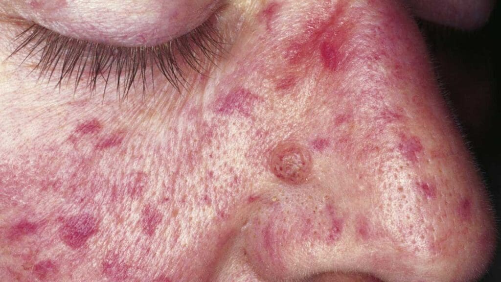 Hereditary hemorrhagic telangiectasia (Osler-Weber-Rendu syndrome = Morbus Osler). Flat, star-shaped skin lesions 1-3 mm in diameter on the entire face. Some non-pulsating telangiectasias appear similar to araneus nevi.