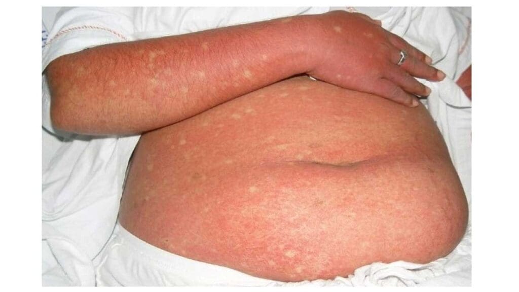 Dengue fever can sometimes cause individual red spots (lesions) to merge, forming a large area of flushed skin (confluent erythema). This rash may also have tiny red dots (petechiae) scattered throughout, with occasional patches of clear skin (white islands) surrounded by the redness, resembling "white islands in a sea of red."